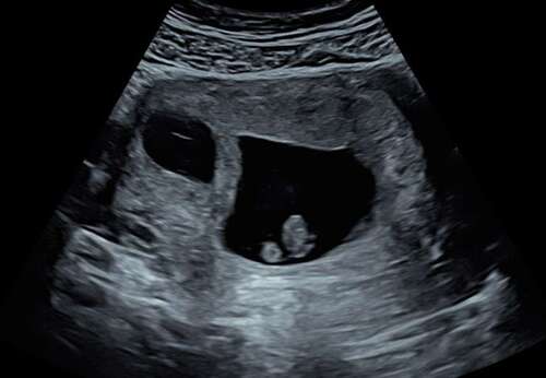 echo lege vruchtzak links verloren tweelinghelft